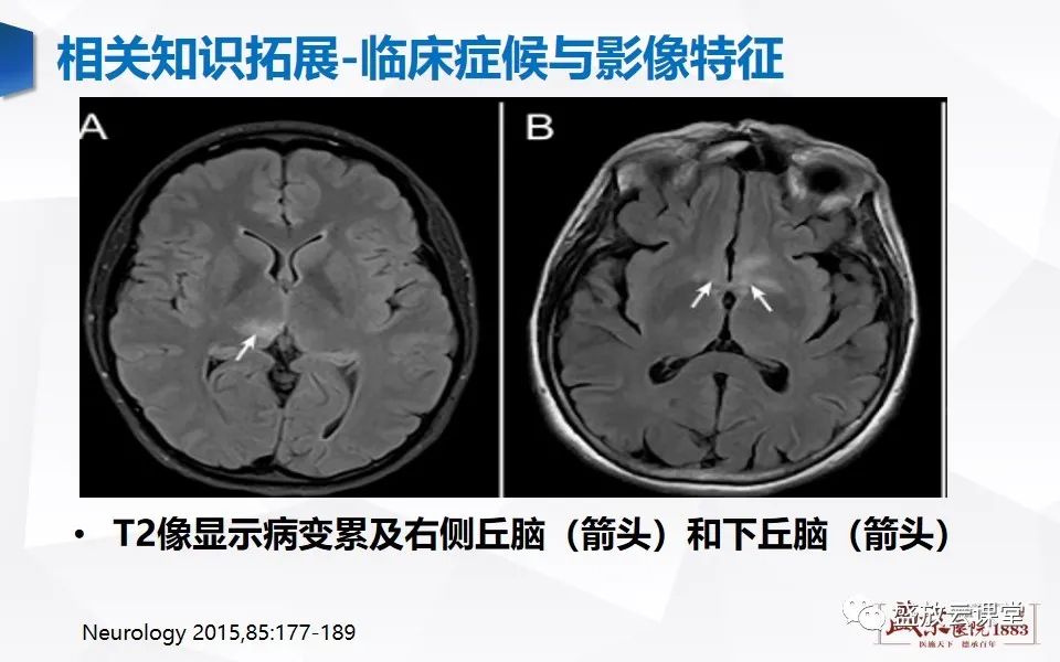 影像PPT - 【PPT】视神经脊髓炎谱系病变-31