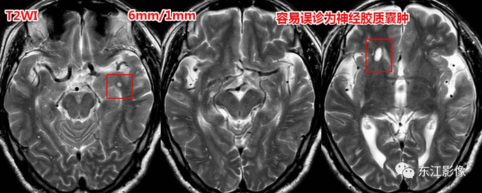 影像PPT - 头颅MRI入门之易误诊影像系列-7 影像PPT - 头颅MRI入门之易误诊影像系列-7