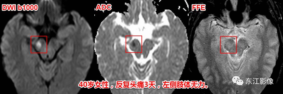影像PPT - 头颅MRI入门之易误诊影像系列-15 影像PPT - 头颅MRI入门之易误诊影像系列-15
