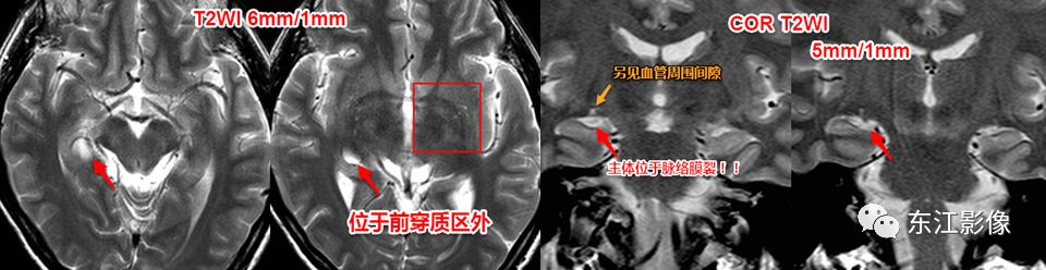 影像PPT - 头颅MRI入门之易误诊影像系列-12 影像PPT - 头颅MRI入门之易误诊影像系列-12
