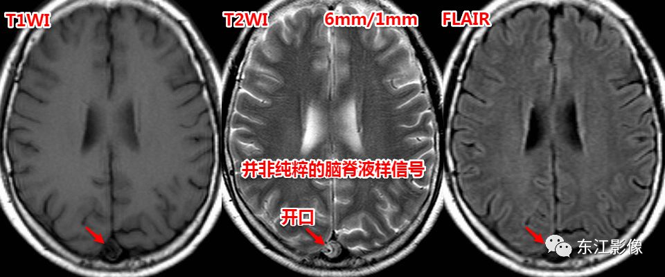 影像PPT - 头颅MRI入门之易误诊影像系列-19 影像PPT - 头颅MRI入门之易误诊影像系列-19