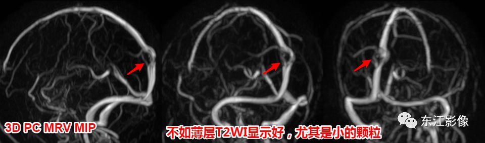 影像PPT - 头颅MRI入门之易误诊影像系列-22 影像PPT - 头颅MRI入门之易误诊影像系列-22