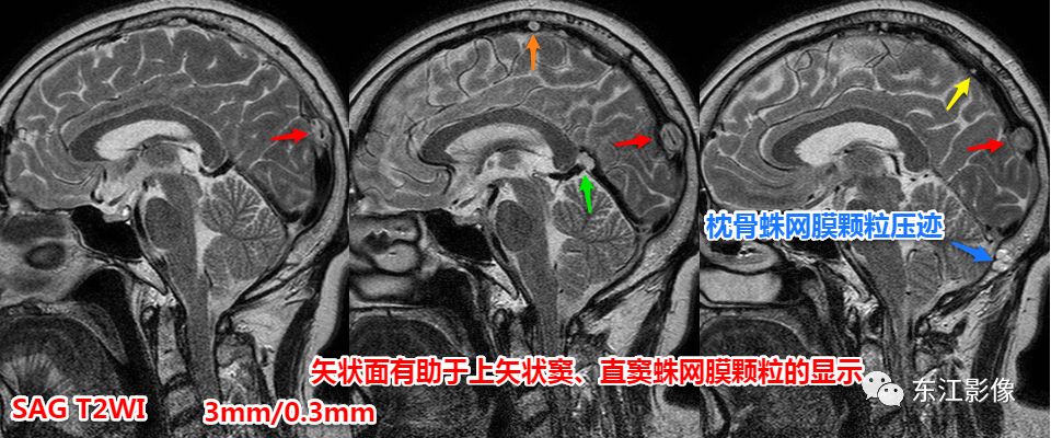 影像PPT - 头颅MRI入门之易误诊影像系列-21 影像PPT - 头颅MRI入门之易误诊影像系列-21