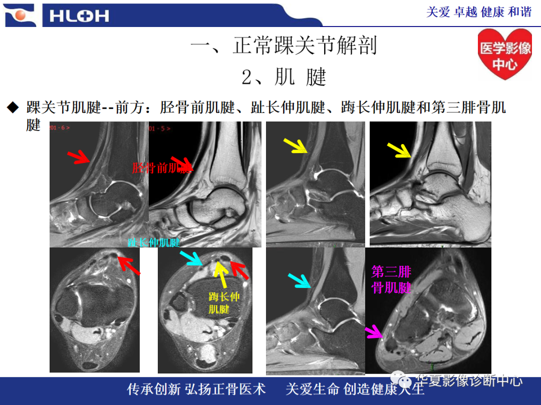 影像PPT - 【PPT】踝关节病变的MRI诊断-11