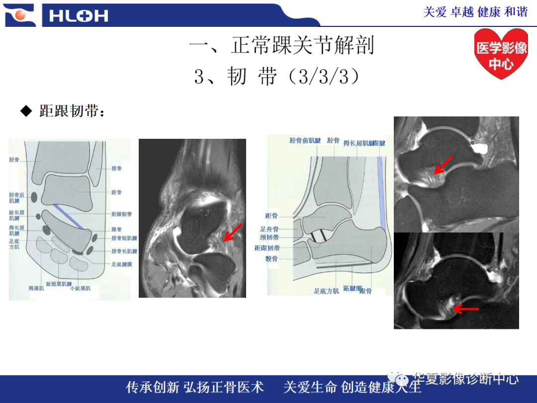 影像PPT - 【PPT】踝关节病变的MRI诊断-25