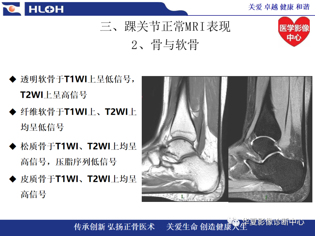 影像PPT - 【PPT】踝关节病变的MRI诊断-33