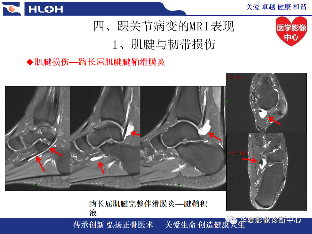 影像PPT - 【PPT】踝关节病变的MRI诊断-38