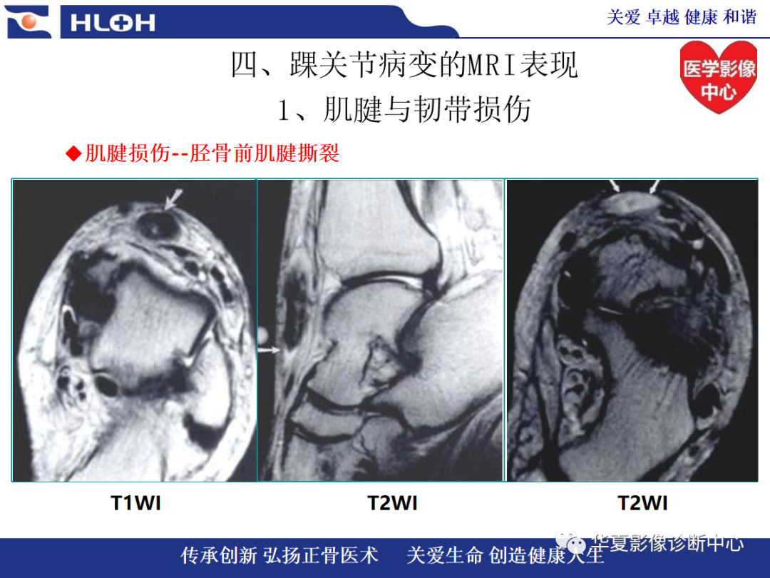 影像PPT - 【PPT】踝关节病变的MRI诊断-42