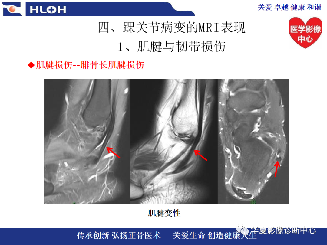 影像PPT - 【PPT】踝关节病变的MRI诊断-46