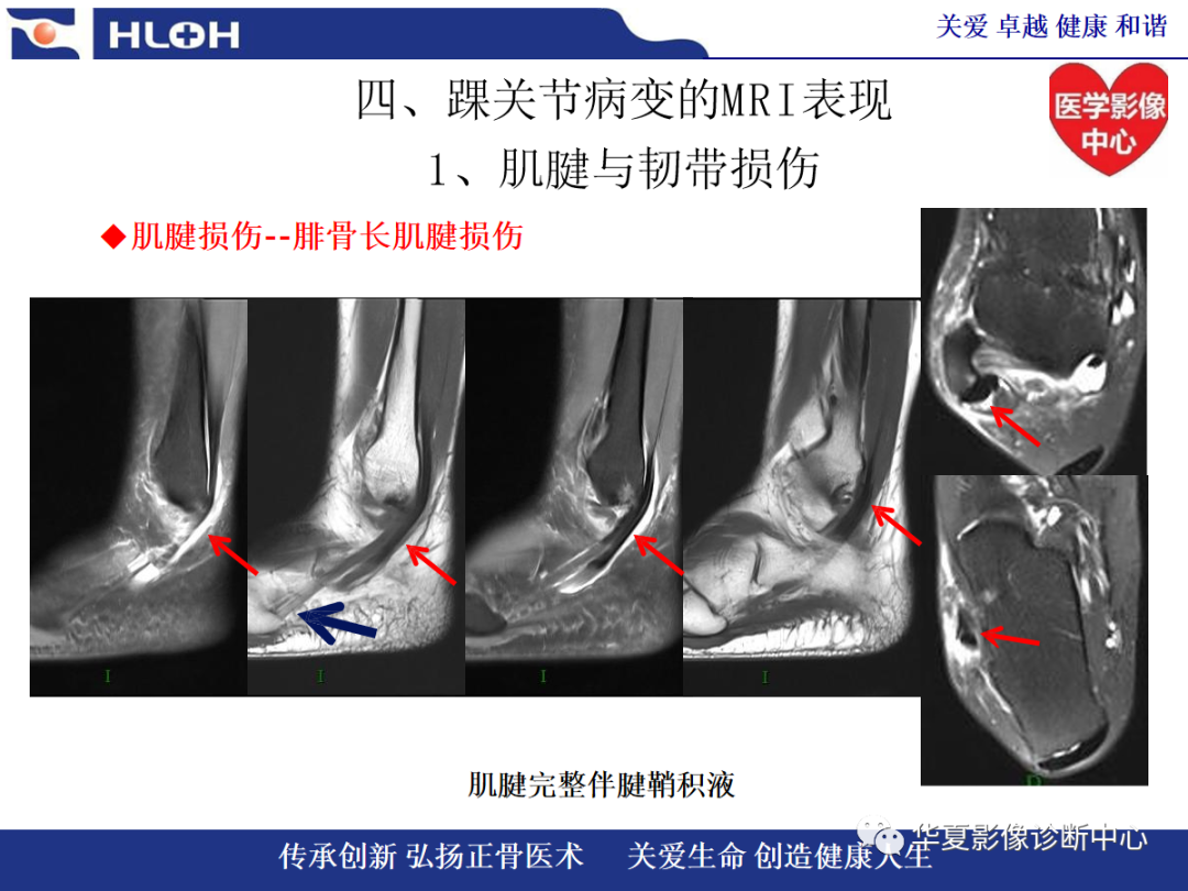 影像PPT - 【PPT】踝关节病变的MRI诊断-47