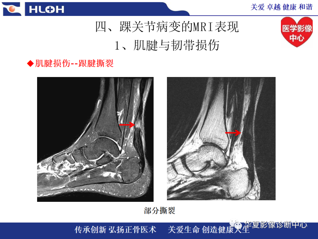 影像PPT - 【PPT】踝关节病变的MRI诊断-54