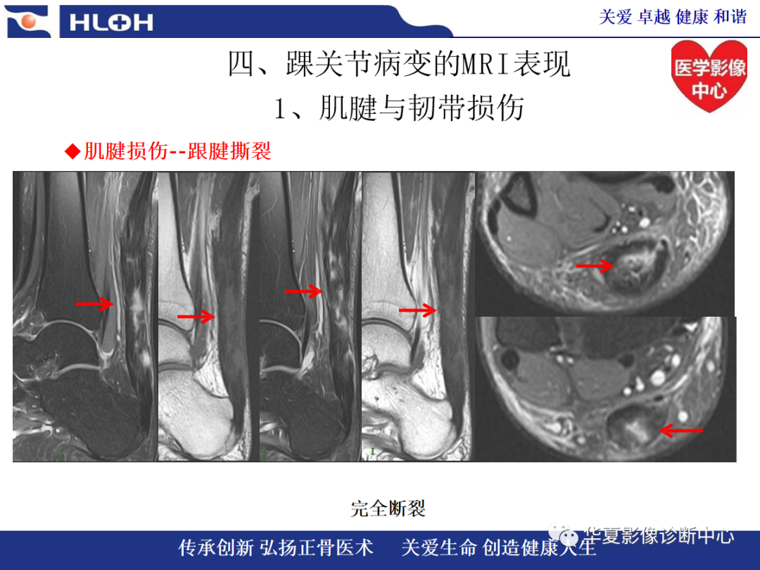 影像PPT - 【PPT】踝关节病变的MRI诊断-55