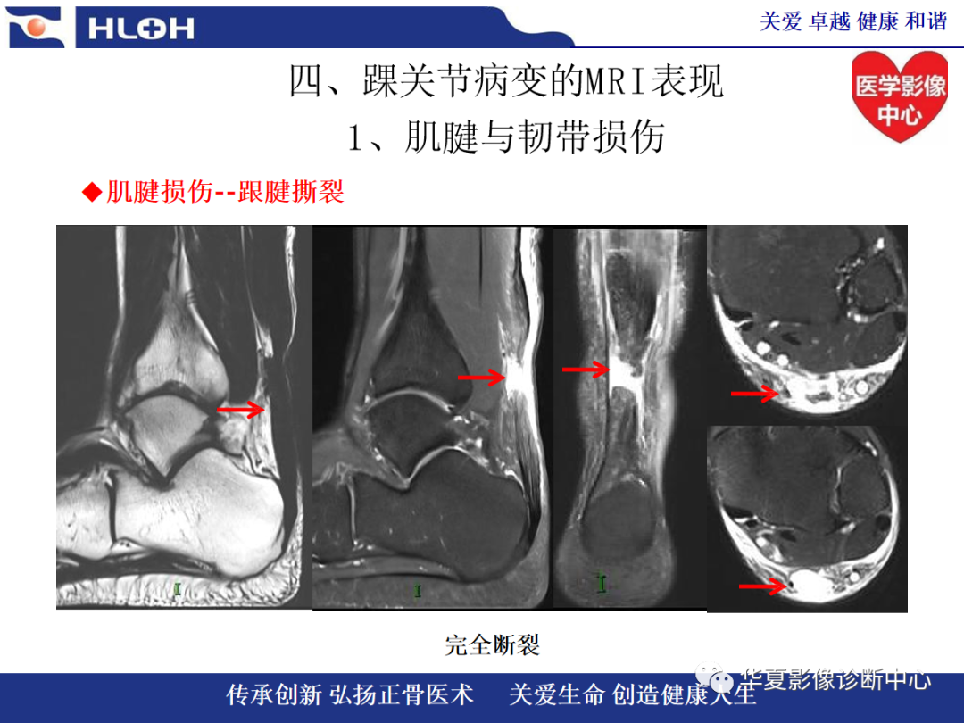 影像PPT - 【PPT】踝关节病变的MRI诊断-56