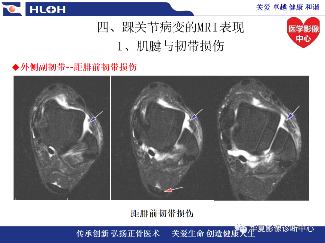 影像PPT - 【PPT】踝关节病变的MRI诊断-63
