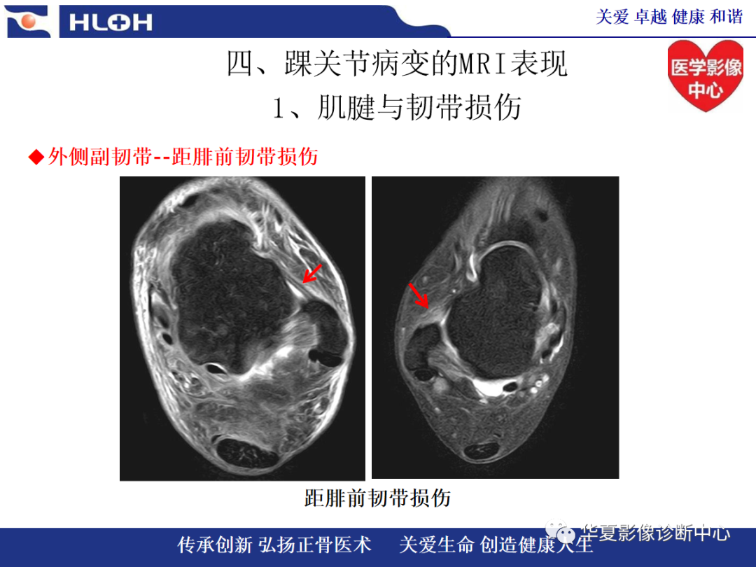 影像PPT - 【PPT】踝关节病变的MRI诊断-64