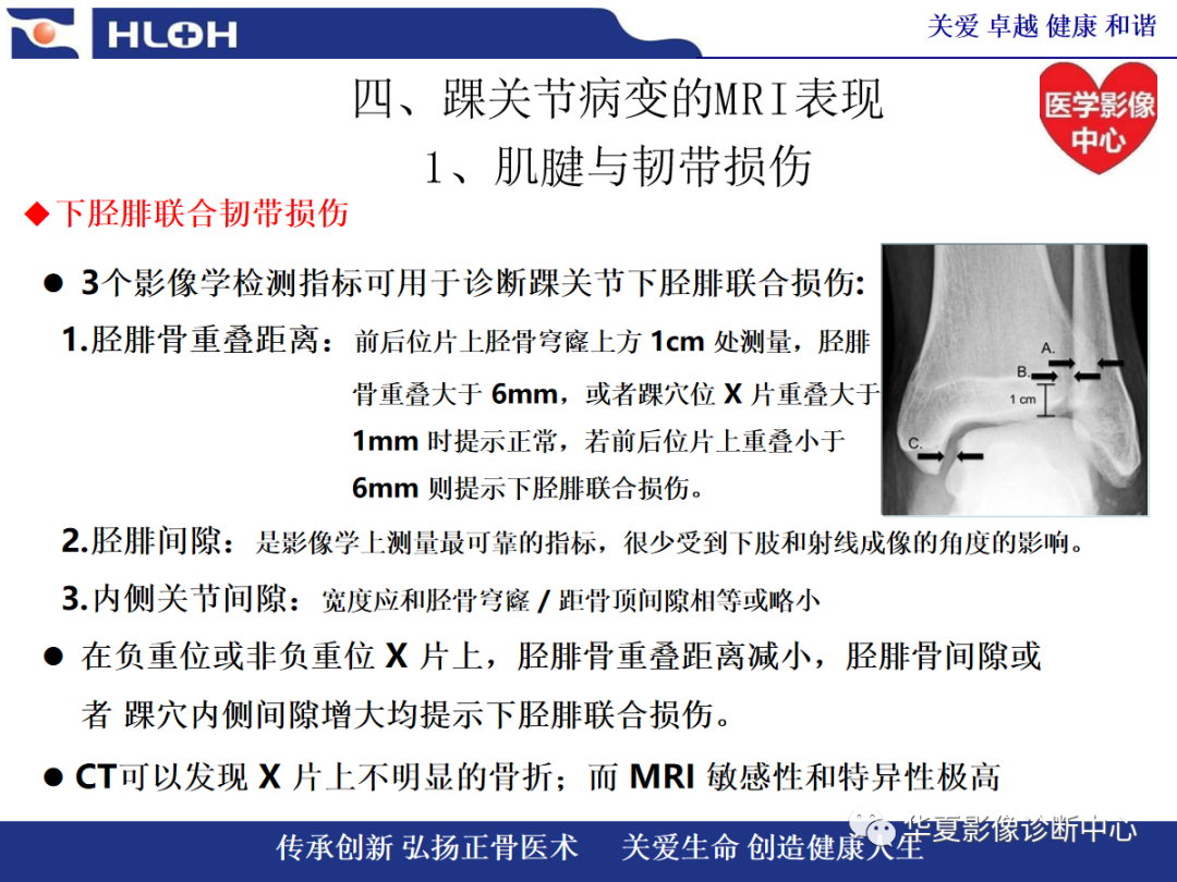 影像PPT - 【PPT】踝关节病变的MRI诊断-75