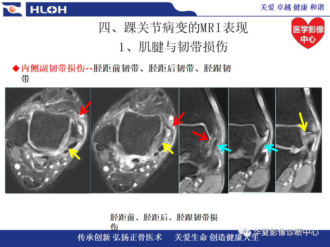影像PPT - 【PPT】踝关节病变的MRI诊断-72