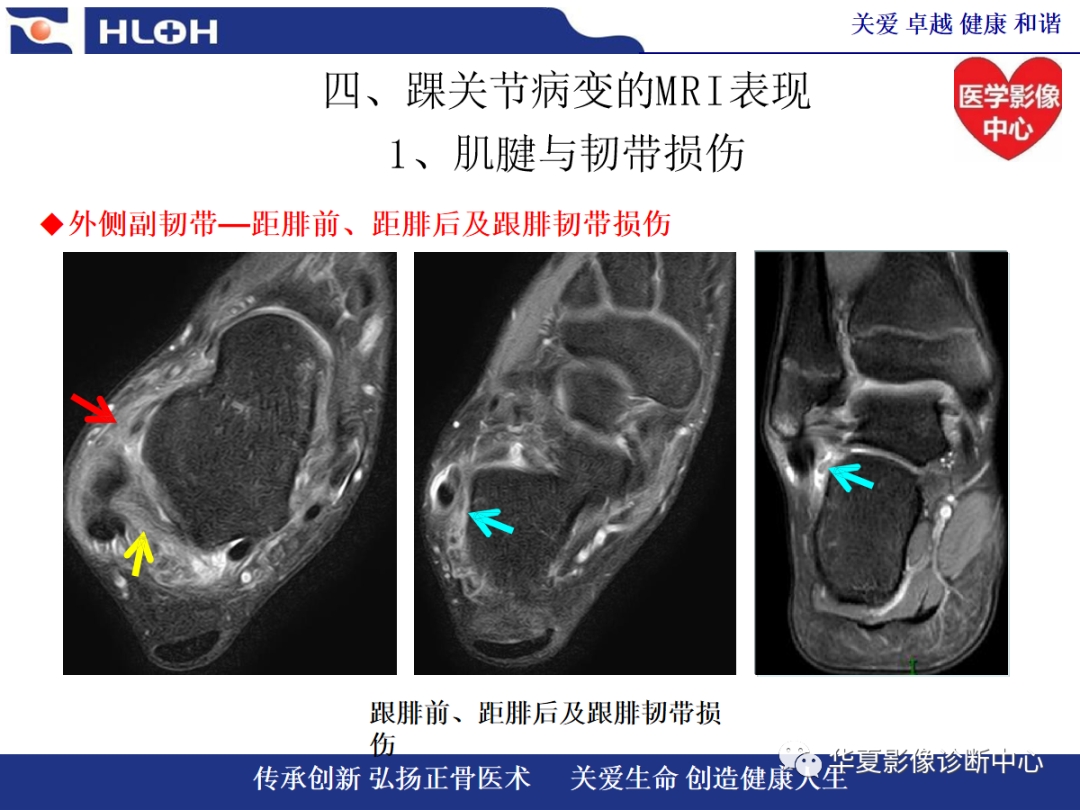 影像PPT - 【PPT】踝关节病变的MRI诊断-70