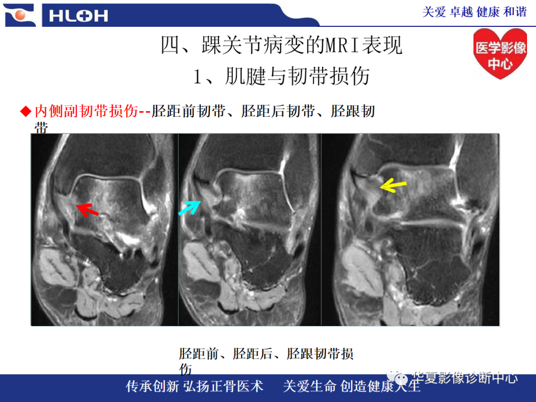 影像PPT - 【PPT】踝关节病变的MRI诊断-73