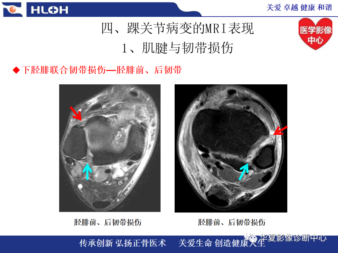 影像PPT - 【PPT】踝关节病变的MRI诊断-77