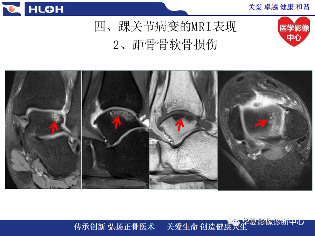 影像PPT - 【PPT】踝关节病变的MRI诊断-84
