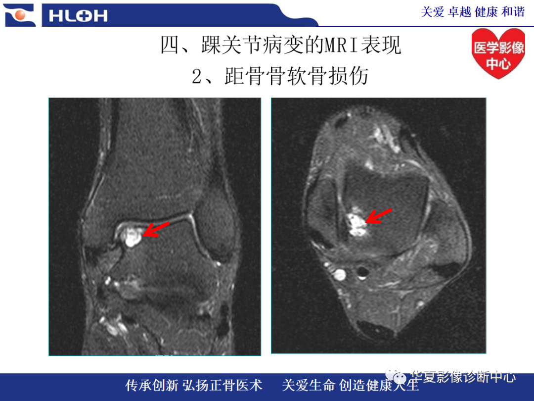 影像PPT - 【PPT】踝关节病变的MRI诊断-83