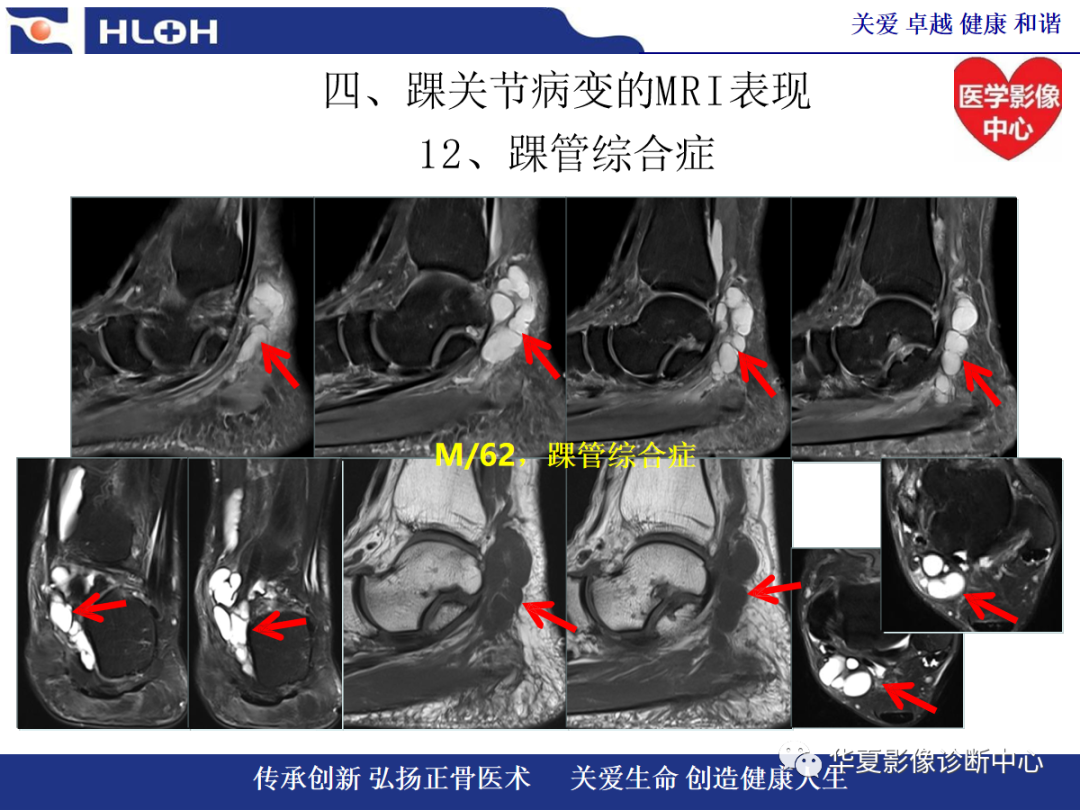 影像PPT - 【PPT】踝关节病变的MRI诊断-143