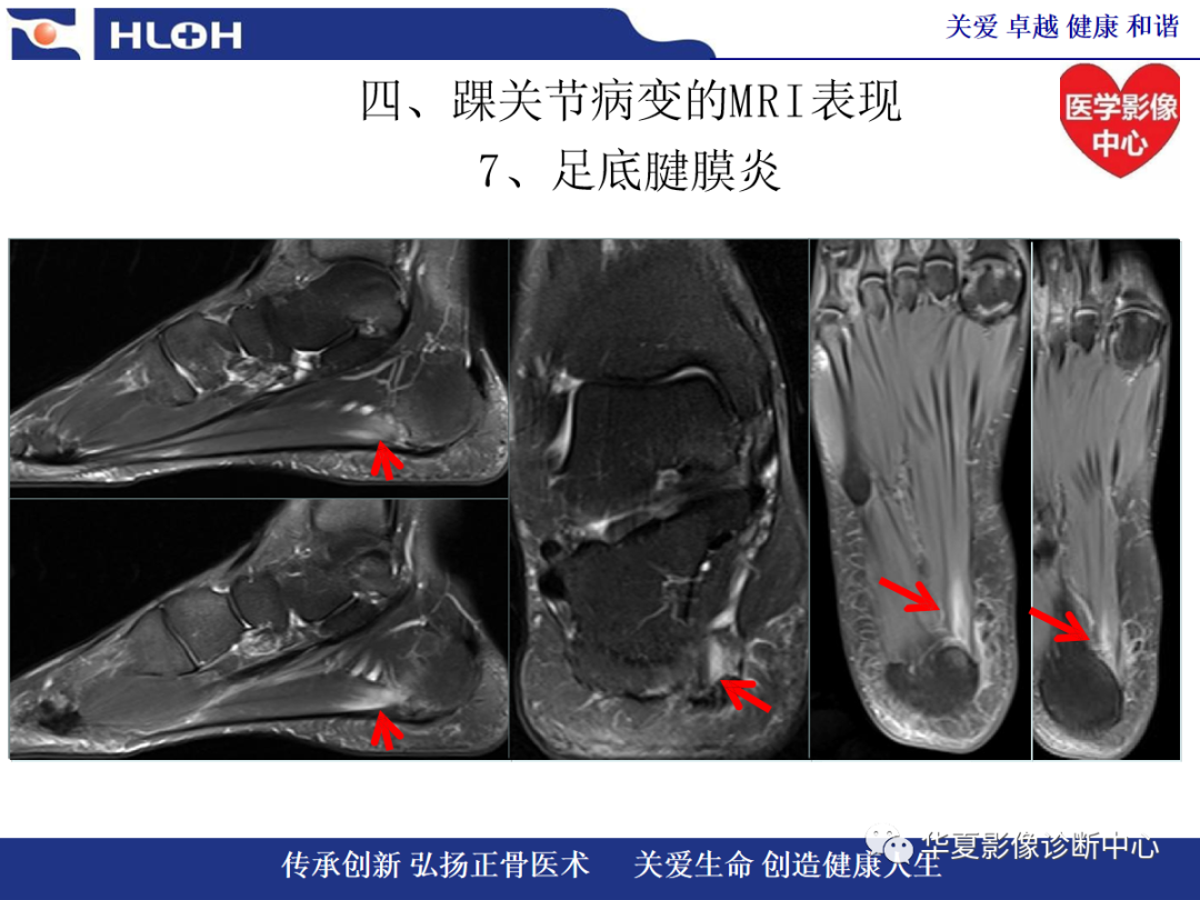 影像PPT - 【PPT】踝关节病变的MRI诊断-129