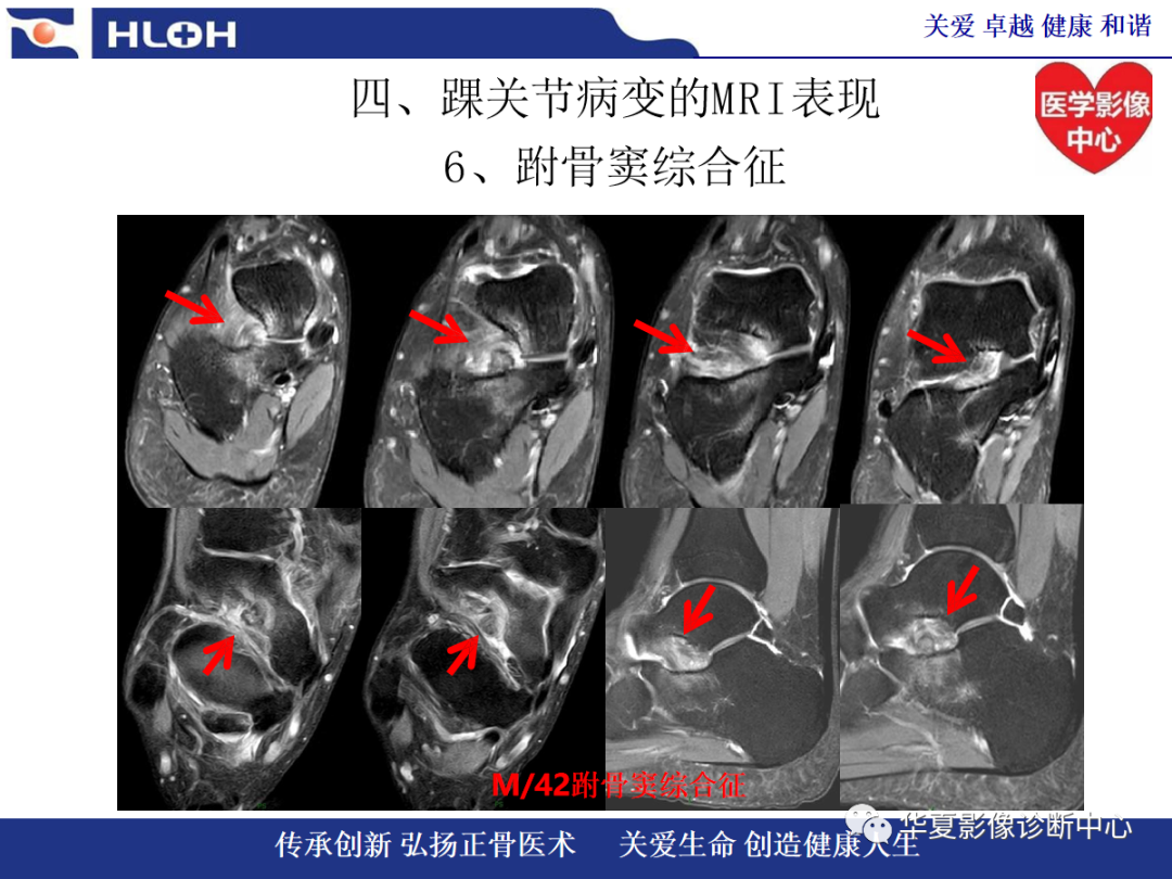 影像PPT - 【PPT】踝关节病变的MRI诊断-123