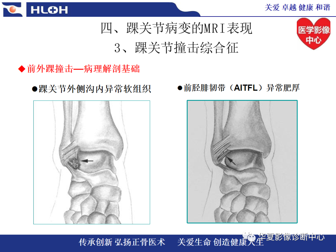 影像PPT - 【PPT】踝关节病变的MRI诊断-97