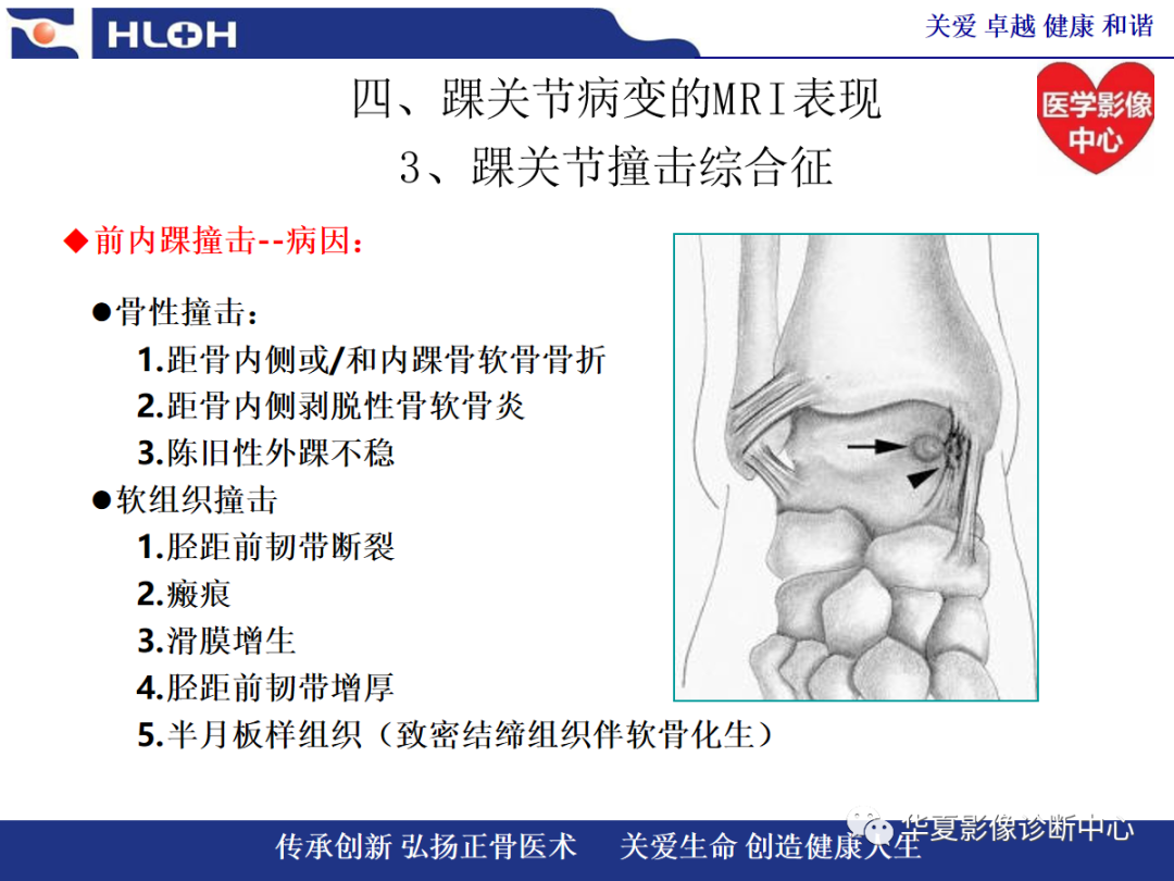 影像PPT - 【PPT】踝关节病变的MRI诊断-101