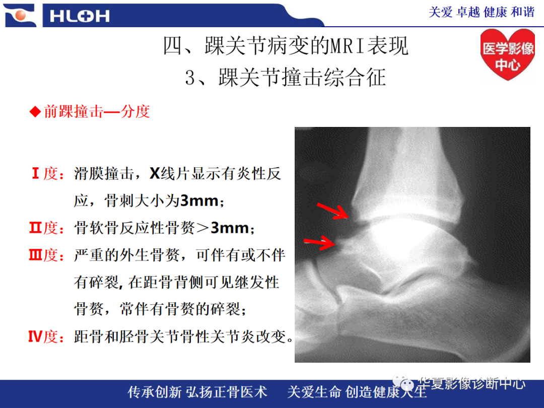 影像PPT - 【PPT】踝关节病变的MRI诊断-92
