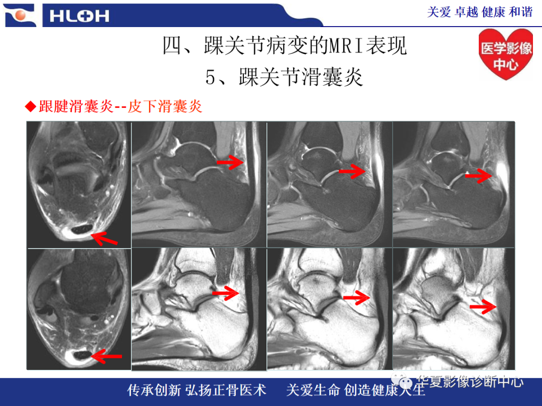 影像PPT - 【PPT】踝关节病变的MRI诊断-117
