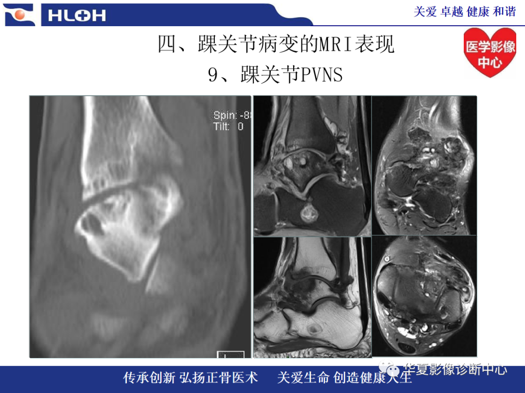 影像PPT - 【PPT】踝关节病变的MRI诊断-136