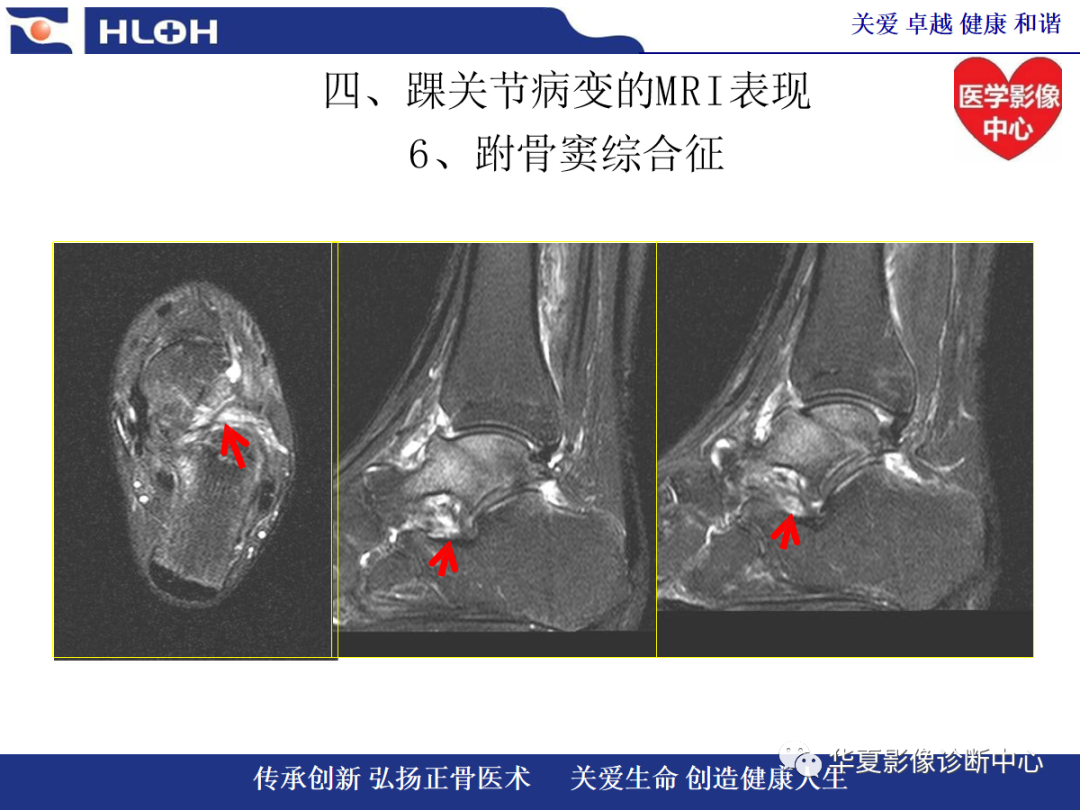 影像PPT - 【PPT】踝关节病变的MRI诊断-125