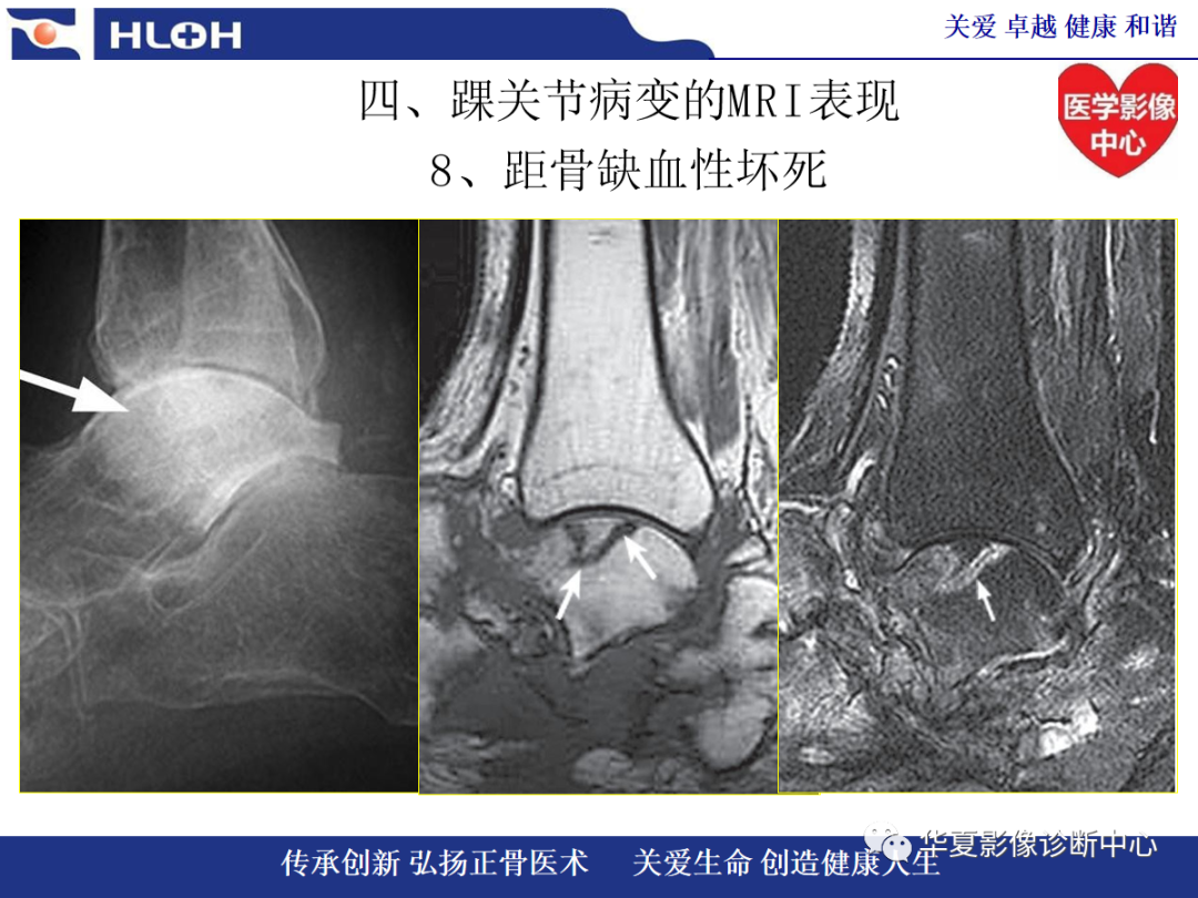 影像PPT - 【PPT】踝关节病变的MRI诊断-132