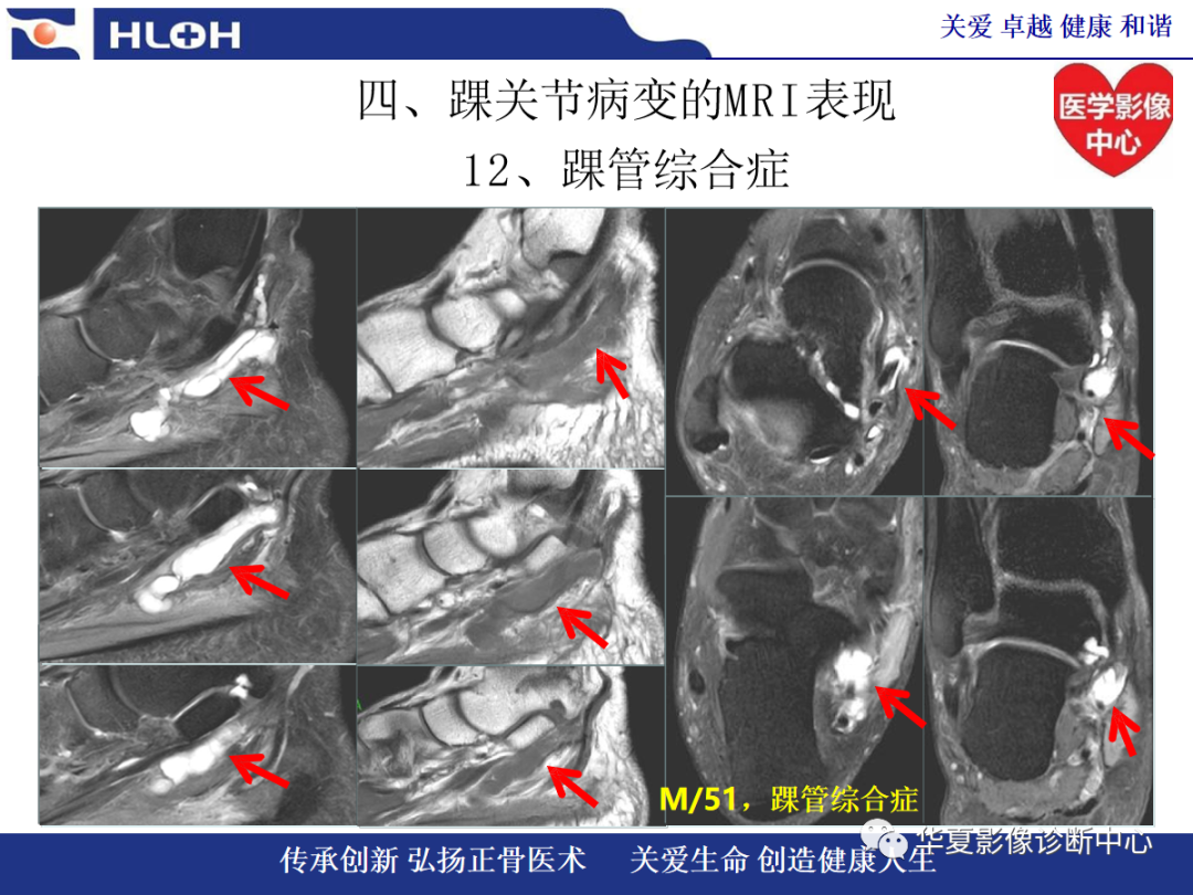 影像PPT - 【PPT】踝关节病变的MRI诊断-144
