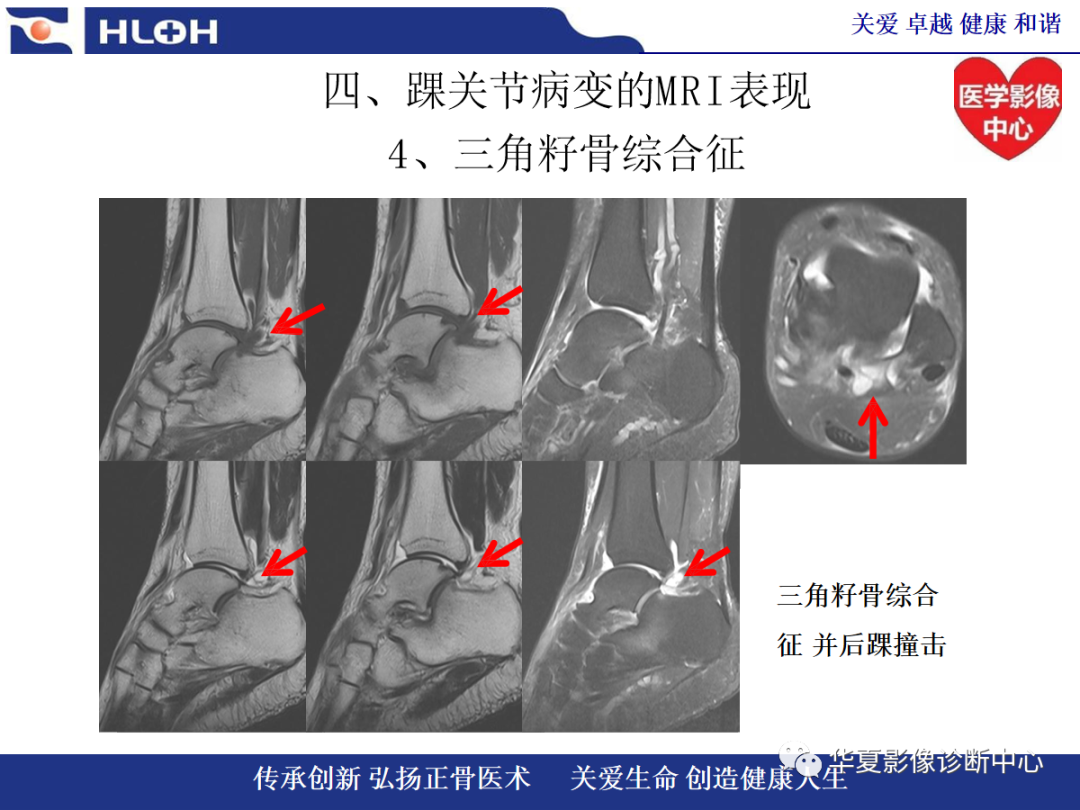 影像PPT - 【PPT】踝关节病变的MRI诊断-110