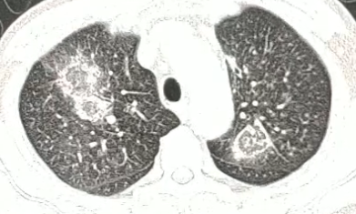 影像PPT - 【病例】肺毛霉菌病1例CT影像-2 影像PPT - 【病例】肺毛霉菌病1例CT影像-2