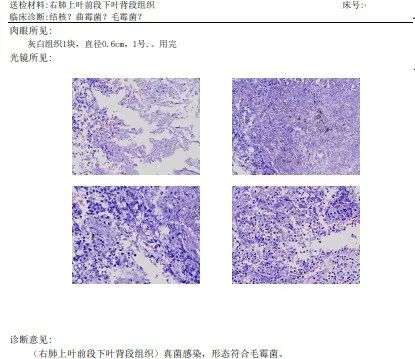 影像PPT - 【病例】肺毛霉菌病1例CT影像-14 影像PPT - 【病例】肺毛霉菌病1例CT影像-14