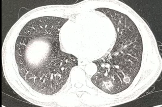 影像PPT - 【病例】肺毛霉菌病1例CT影像-11 影像PPT - 【病例】肺毛霉菌病1例CT影像-11