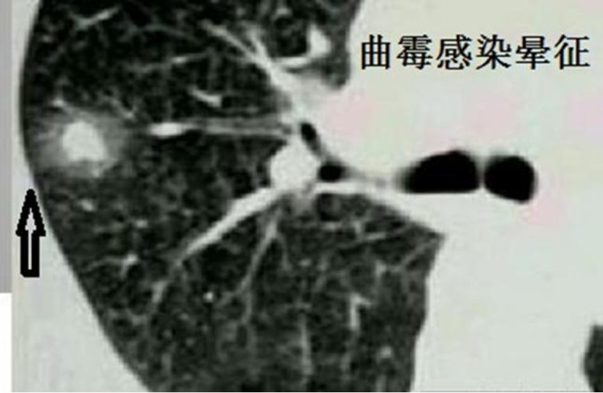 影像PPT - 【病例】肺毛霉菌病1例CT影像-12 影像PPT - 【病例】肺毛霉菌病1例CT影像-12