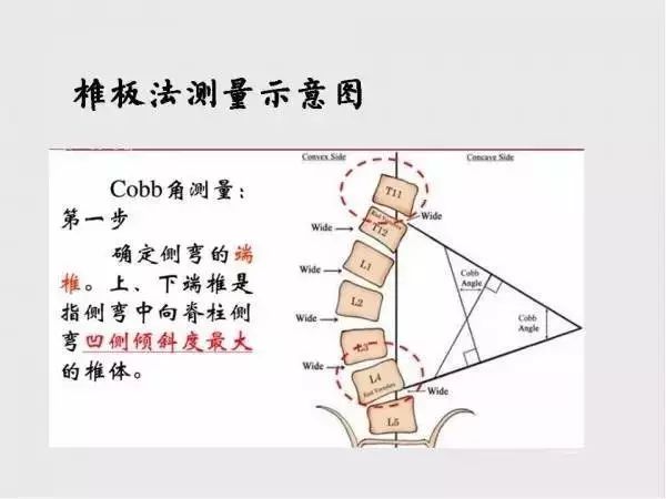影像PPT - 【PPT】脊柱侧凸相关测量-8