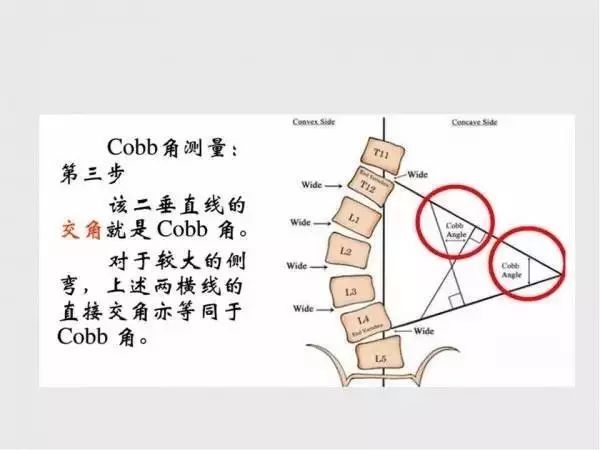 影像PPT - 【PPT】脊柱侧凸相关测量-10