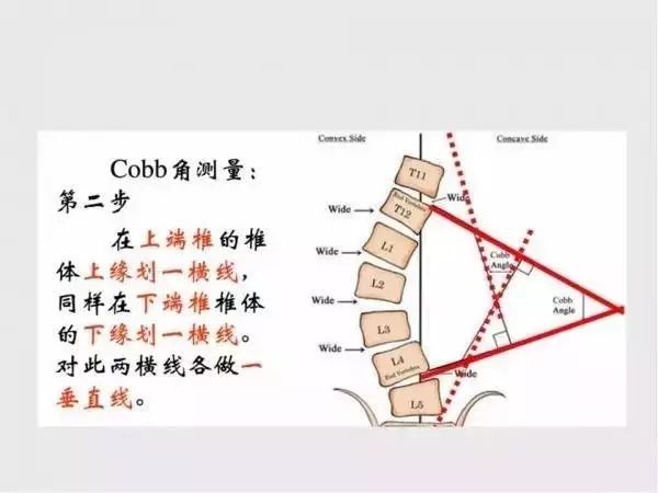 影像PPT - 【PPT】脊柱侧凸相关测量-9