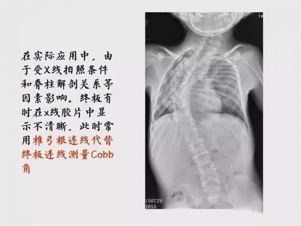 影像PPT - 【PPT】脊柱侧凸相关测量-13