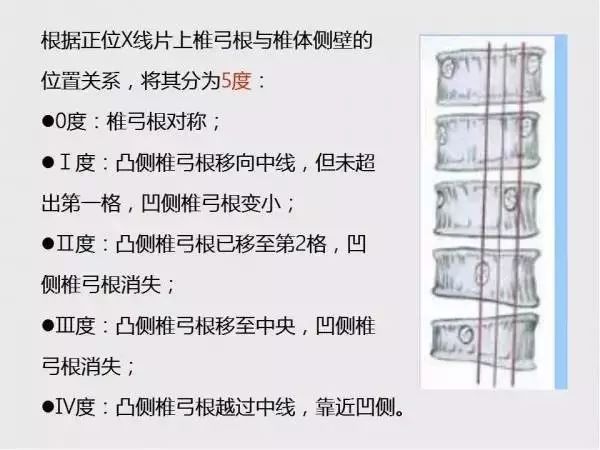 影像PPT - 【PPT】脊柱侧凸相关测量-21