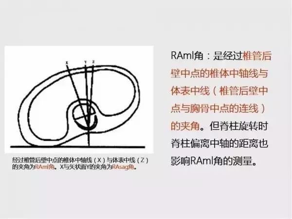 影像PPT - 【PPT】脊柱侧凸相关测量-26
