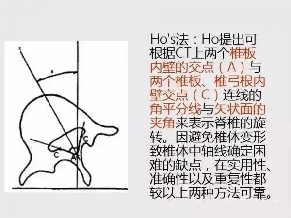 影像PPT - 【PPT】脊柱侧凸相关测量-27