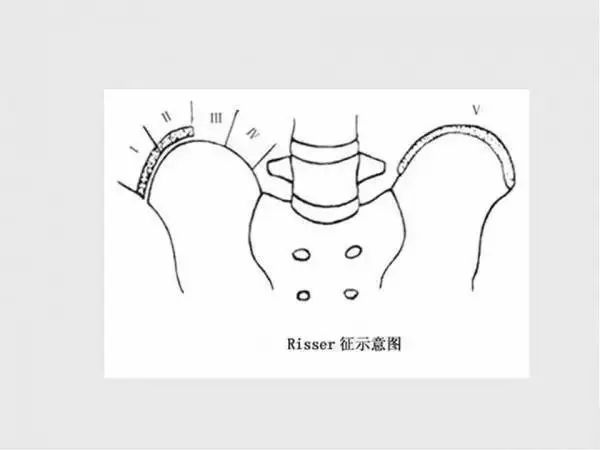 影像PPT - 【PPT】脊柱侧凸相关测量-33